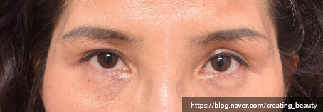눈썹하거상술(Subbrow lift, Sub-browpexy)이 필요한 경우를 성형외과 전문의가 설명해 드립니다. 관련 이미지 5