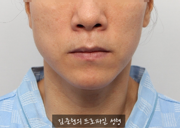 수술없이 간단하게 안면비대칭, 턱끝 비대칭(미드라인 맞추기) 해결하기!! 관련 이미지 2