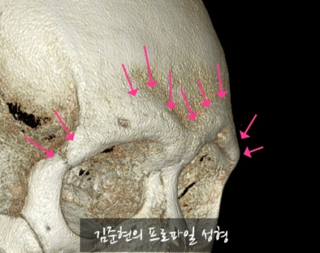 Let’s Learn About the Effects of Brow Bone Reduction Surgery. (Brow Bone? Eye Hole Bone? Here’s a Terminology Guide.) image 16