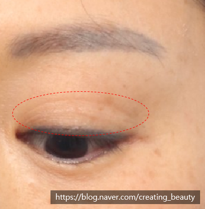 겹주름 있는 짝눈!! 짝눈교정 방법에 대하여 성형외과 전문의가 설명해 드립니다. (절개눈매교정 & 눈위 지방이식) 관련 이미지 5