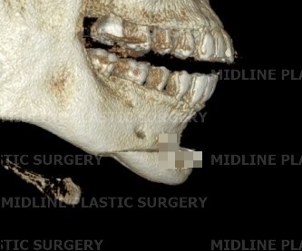 A Specialist Explains Chin Advancement Surgery After Removal of a Receded Chin Implant image 7