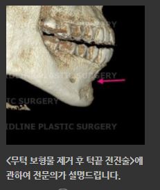 필러&middot;보형물 부작용, 골흡수 됐을 때 해결 방법은? 관련 이미지 10