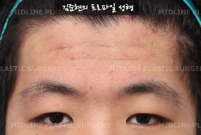 How Can Deep Forehead Wrinkles Be Resolved? (Feat. Forehead Lift + Filler) image 5
