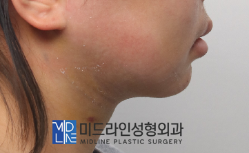 A Plastic Surgery Specialist Explains Why Chin Liposuction Is Sometimes Essential Because Jaw Reduction Surgery Alone Has Limited Effect image 7