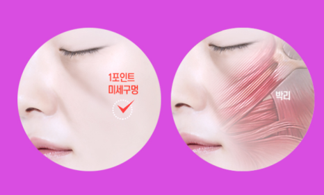 인디언 주름 고민 해결! 중안면부 리프팅에 대하여 설명드립니다. 관련 이미지 21