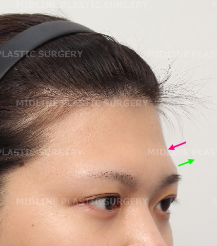 Forehead Lift for a Forehead with Prominent Brow Bones?? image 4