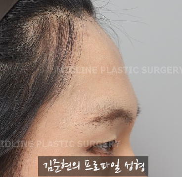눈썹뼈절삭, 어떨 때 어떻게 하는 수술일까요? 꼭 이마거상과 함께 해야만 하는 수술인가요? 미드라인성형외과에서 하는 눈썹뼈절삭 수술을 설명드립니다. (3D CT 있음) 관련 이미지 12
