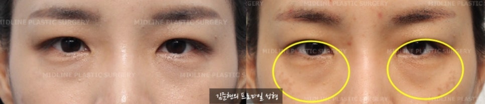 이마거상이 필요한 전형적인 케이스를 소개합니다! 더 일찍 할 껄ㅠㅠ하지 마시고 지금이 제일 빠를 때입니다. (Feat. 눈밑지방재배치와 눈밑지방이식) 관련 이미지 2