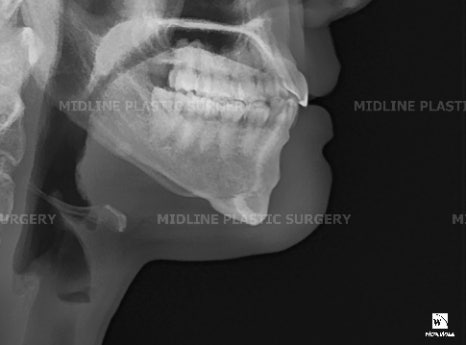 Fixing a Sagging Double Chin After Contouring Surgery! Let’s Learn About Mid-Up Lifting 2040. image 4