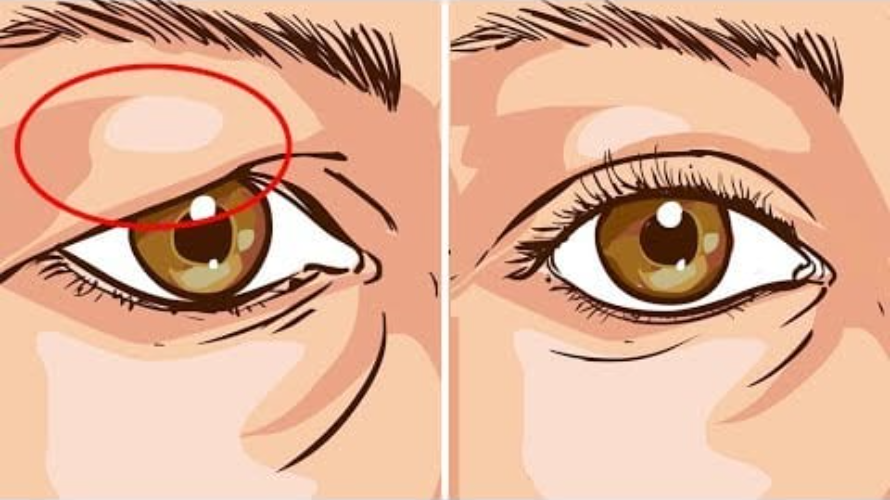 눈썹하거상술(Subbrow lift, Sub-browpexy)이 필요한 경우를 성형외과 전문의가 설명해 드립니다. 관련 이미지 1