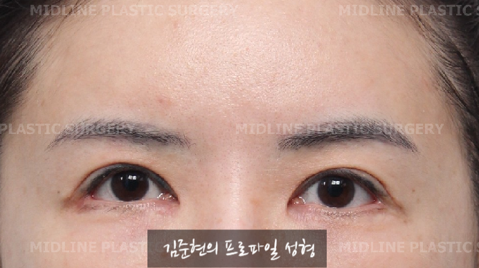 The outer corners of my eyes are open and my eyes stingㅠㅠI had lateral canthoplasty revision and eye corner restoration.(feat. Endoscopic forehead lift) image 1