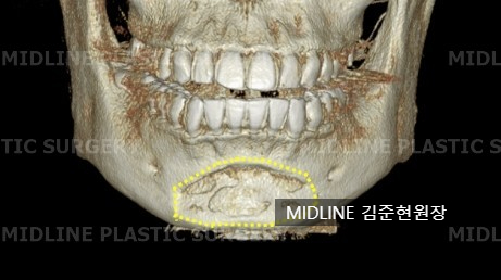 윤곽 후 핀제거 수술 케이스, 꼭 필요한 것인가? 관련 이미지 5