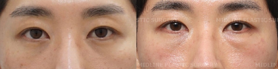 I Want to Get Rid of the Foreign Material Under My Eyes (Radiesse)ㅠ A Plastic Surgeon Explains Cases of Under-Eye Foreign Material Removal image 1