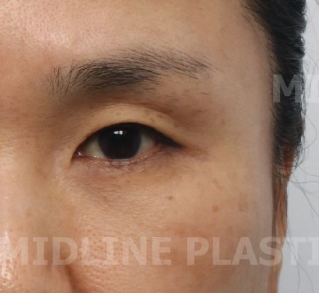 What Type of Plastic Surgery Is Needed for Small, Cramped Eyes? (About Lateral, Lower, and Combined Lateral-Lower Canthoplasty) image 19