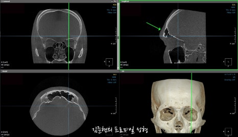 눈썹뼈절삭, 어떨 때 어떻게 하는 수술일까요? 꼭 이마거상과 함께 해야만 하는 수술인가요? 미드라인성형외과에서 하는 눈썹뼈절삭 수술을 설명드립니다. (3D CT 있음) 관련 이미지 21