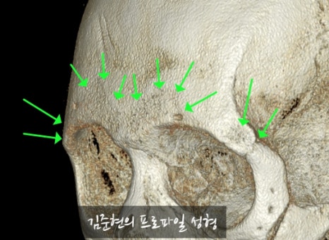 Let’s Learn About the Effects of Brow Bone Reduction Surgery. (Brow Bone? Eye Hole Bone? Here’s a Terminology Guide.) image 29