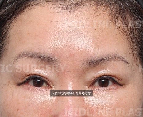 콧등 보톡스로 해결할 수 없는 콧등 가로주름!! 근본적인 해결에 대하여 알려드립니다. 관련 이미지 8