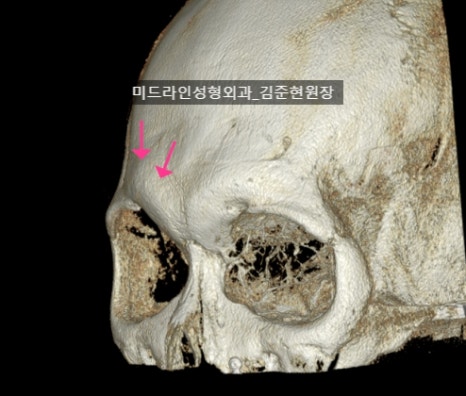 눈썹뼈 절삭에 관하여 (안와상융기) 관련 이미지 8