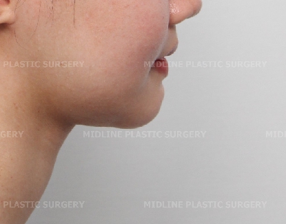 Fixing a Sagging Double Chin After Contouring Surgery! Let’s Learn About Mid-Up Lifting 2040. image 10