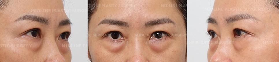 I don’t like bulging under-eye fat, dark circles, or wrinkles under the eyes. I’ll explain the no-touch lower blepharoplasty and fat grafting procedure. image 4