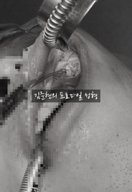 안전하고 예측 가능한 광대축소술. 성형외과 전문의가 알려드립니다. (feat. 미드라인성형외과) 관련 이미지 8