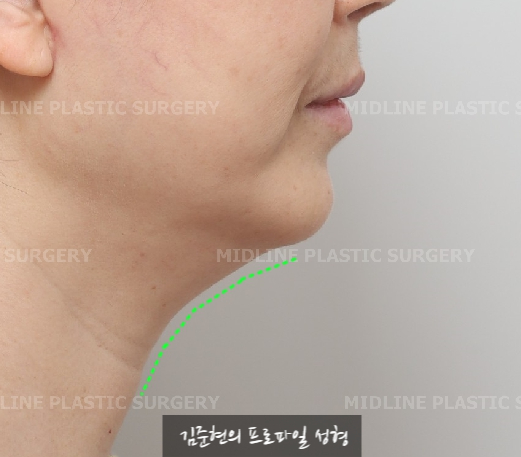이중턱 근육 묶길 잘했어요^-^ 이중턱 근육묶기와 근육 밑 지방(포도송이 지방)제거까지 성형외과 전문의가 설명드립니다. 관련 이미지 3