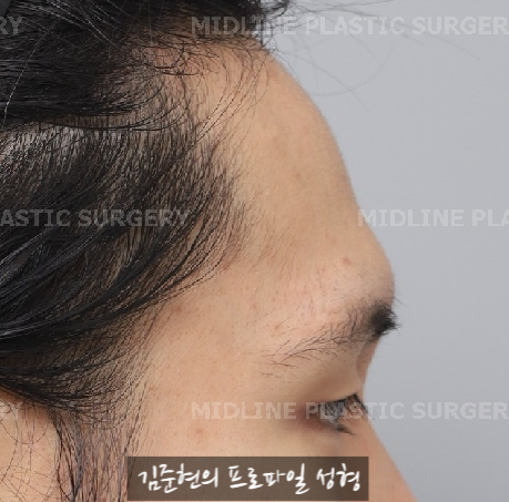 눈썹뼈절삭, 어떨 때 어떻게 하는 수술일까요? 꼭 이마거상과 함께 해야만 하는 수술인가요? 미드라인성형외과에서 하는 눈썹뼈절삭 수술을 설명드립니다. (3D CT 있음) 관련 이미지 1