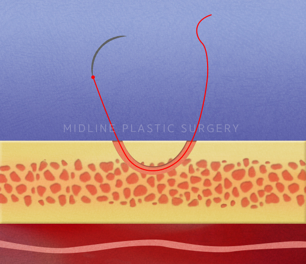 Forehead Lift! Endotine vs Absorbable Thread — Explaining the Differences in Results and Side Effects image 7