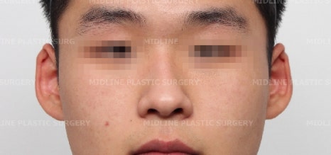 휜 코, 매부리 교정과 기능코-비중격만곡증까지 바로잡기 관련 이미지 20