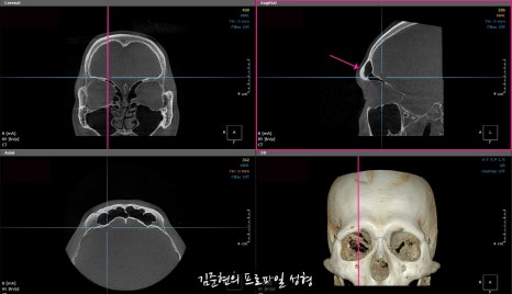 눈썹뼈절삭, 어떨 때 어떻게 하는 수술일까요? 꼭 이마거상과 함께 해야만 하는 수술인가요? 미드라인성형외과에서 하는 눈썹뼈절삭 수술을 설명드립니다. (3D CT 있음) 관련 이미지 24