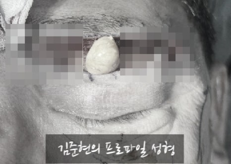 처지고 통통한(Puffy) 눈꺼풀 탈출하기!눈썹하거상(Subbrow lift)과 눈 위 지방제거(Feat. 하안검, 지방이식) 관련 이미지 6