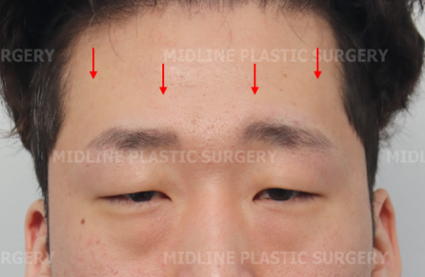 <2편> 쌍꺼풀 수술 없이 눈을 크게 만드는 방법을 성형외과 전문의가 직접 설명드립니다. 관련 이미지 3