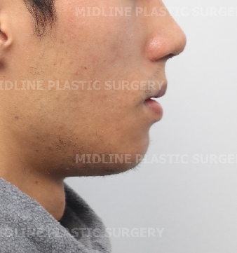 A Plastic Surgeon Explains the Changes in the Front and Side Views After Reduction Genioplasty and Advancement Genioplasty. (Feat. Rhinoplasty) image 12