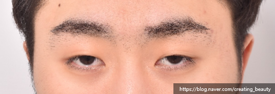 반드시 절개눈매교정으로 해야 하는 경우를 성형외과 전문의가 알려드립니다. 관련 이미지 5