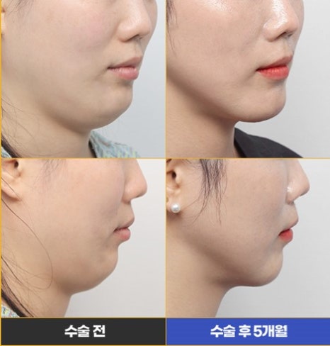 Fixing a Sagging Double Chin After Contouring Surgery! Let’s Learn About Mid-Up Lifting 2040. image 20