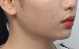 A Plastic Surgery Specialist Explains Why Chin Liposuction Is Sometimes Essential Because Jaw Reduction Surgery Alone Has Limited Effect image 5
