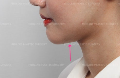 Fixing a Sagging Double Chin After Contouring Surgery! Let’s Learn About Mid-Up Lifting 2040. image 16