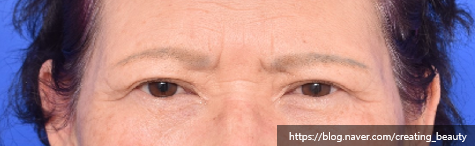눈썹하거상술(Subbrow lift, Sub-browpexy)이 필요한 경우를 성형외과 전문의가 설명해 드립니다. 관련 이미지 3
