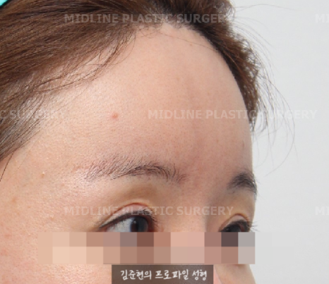 I want to go back to how it was before the forehead liftㅠ Is forehead lift reversal or release possible? image 5