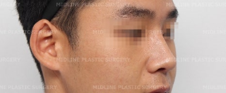 휜 코, 매부리 교정과 기능코-비중격만곡증까지 바로잡기 관련 이미지 29