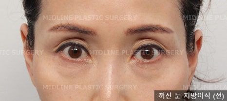 Sallow Eyes, Sunken Eyes Solved with Fat Grafting! (Feat. Dark Circles) image 9