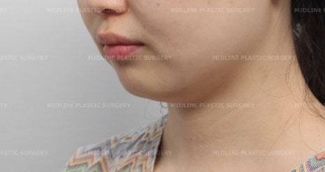 노마스크 시대를 대비한 턱끝전진술과 미드업2040으로 턱선만들기!! 관련 이미지 11