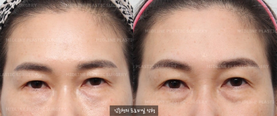 눈밑지방재배치 수술 전 눈밑 필러를 녹여야 하는 이유에 관하여 성형외과 전문의가 설명드립니다. (Feat. 이마거상) 관련 이미지 2