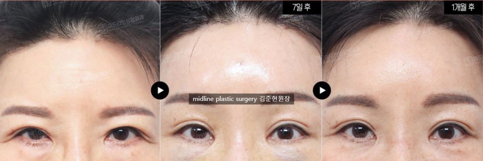 Headache, vomiting, pain, nausea after forehead lift... is it a side effect?! Here's my answer. image 4