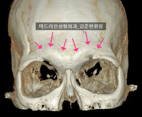 눈썹뼈 절삭에 관하여 (안와상융기) 관련 이미지 14