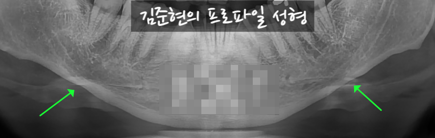 턱끝전진술로 생긴 이차각은 어떻게 되나요?! 관련 이미지 8