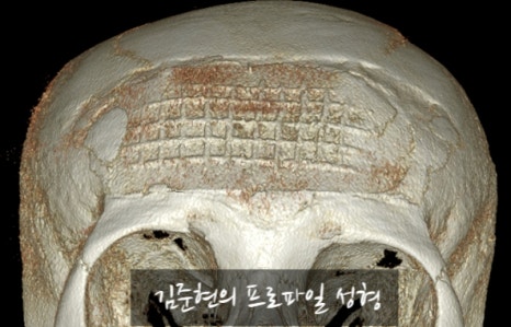 I Removed Two Forehead Implants. A Board-Certified Plastic Surgeon Explains Why I Do Not Recommend Forehead Implants. image 17