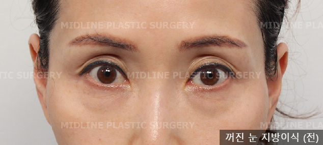 Sallow Eyes, Sunken Eyes Solved with Fat Grafting! (Feat. Dark Circles) image 7