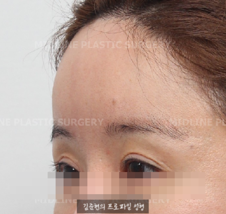 I want to go back to how it was before the forehead liftㅠ Is forehead lift reversal or release possible? image 7