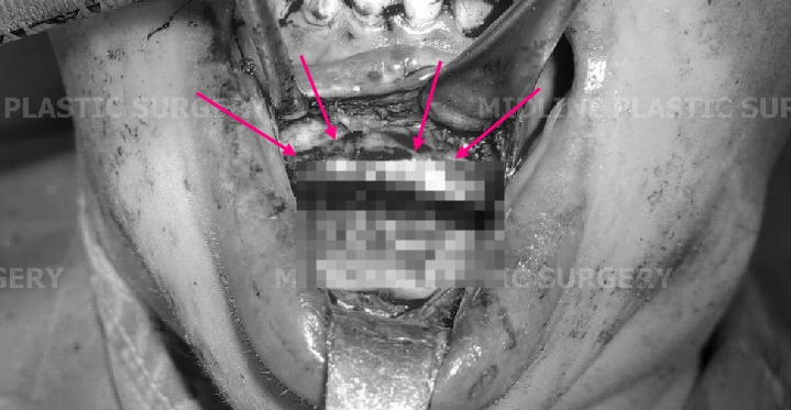 A Specialist Explains Chin Advancement Surgery After Removal of a Receded Chin Implant image 5